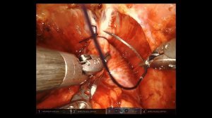 Full Narrated Robotic-Assisted Prostatectomy | Global Robotics Institute | AdventHealth