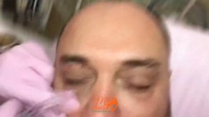 Убираем темные круги под глазами. Биоревитализация MESOEYE C71