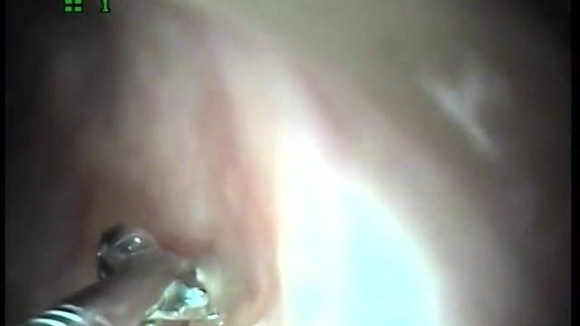 кот Рыжик колоноскопия диагноз "лимфоцитарно-плазмоцитарный колит" (Тарасова НК) смотреть онлайн