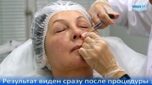 Коррекция носослезной борозды контурной пластикой