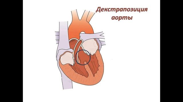 Сердце: аномалии развития смотреть онлайн