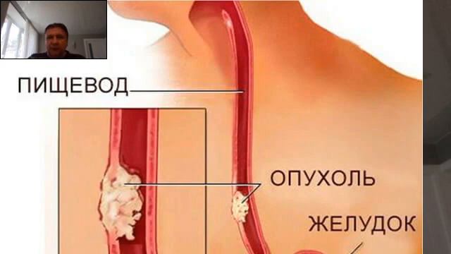 Рак. Очень серьезные болезни