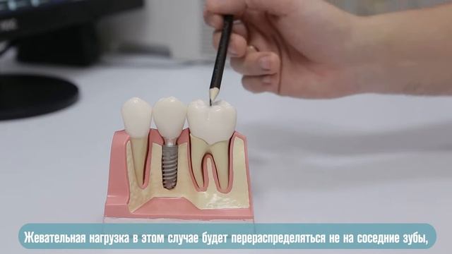 Этапы имплантации: особенности и сроки