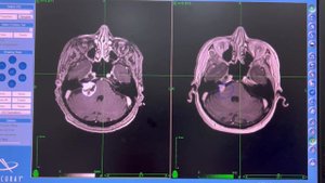 Невринома слухового нерва и КиберНож