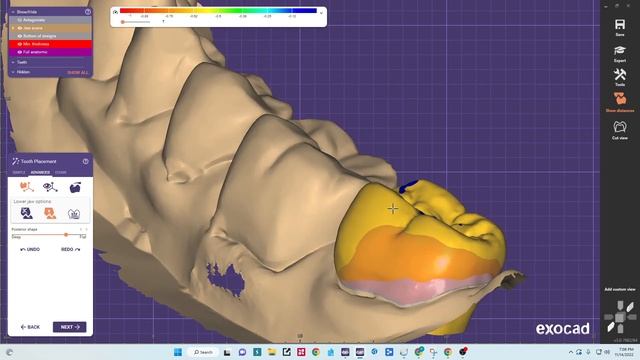 Exocad dental crown design tips смотреть онлайн