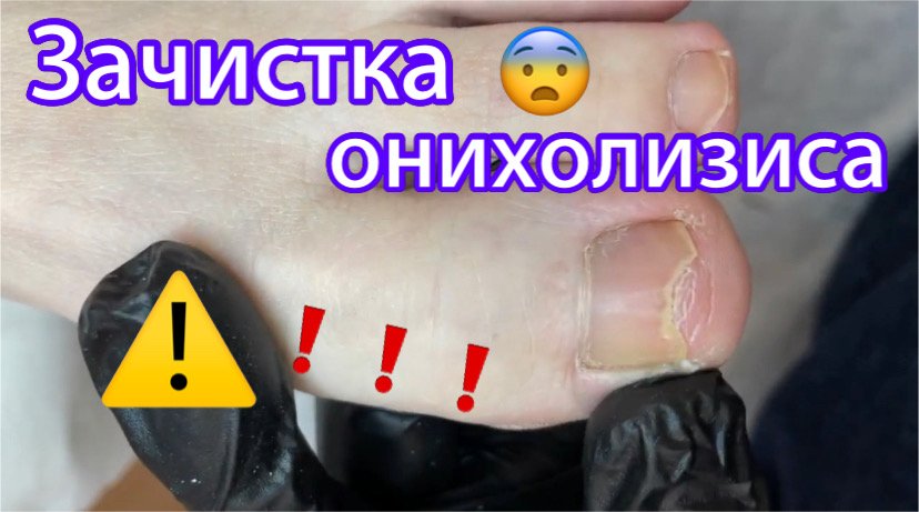 Зачистка онихолизиса ?⚠️❗️??