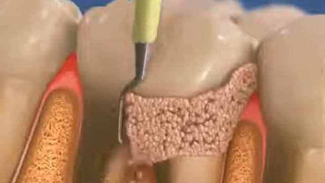 Ультразвуковая чистка зубов в Полтаве смотреть онлайн