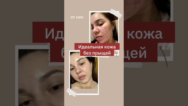 #зинерит #папула #пустула #акне #эритема #ниацинамид #салициловаякислота #пилинглица #постакне #пп