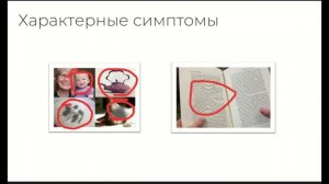 Возрастная макулярная дистрофия