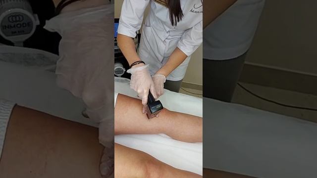 Morpheus 8 - аппаратное омоложение кожи и подтяжка кожи. смотреть онлайн