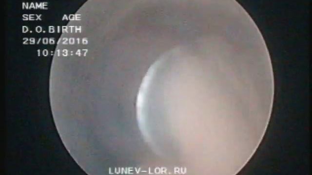Удаление гребня перегородки носа эндоскопическая лазерная кристотомия 29062016 2