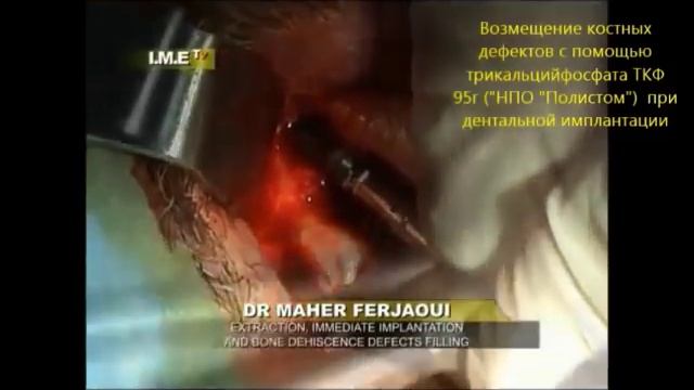 Возмещение костных дефектов смотреть онлайн
