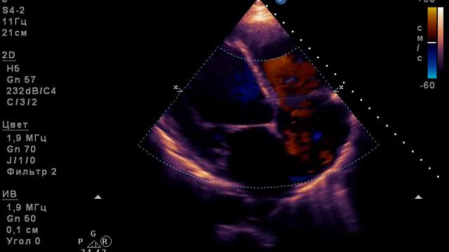 подвижная структура в срединном сегменте МЖП 1 смотреть онлайн