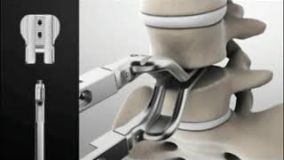 Установка протеза межпозвонкового поясничного диска M6-L смотреть онлайн