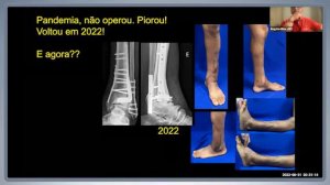 Webinar: “Fratura do pilão tibial 43 C3" - 31/08/2022