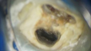 повторная эндодонтия моляра