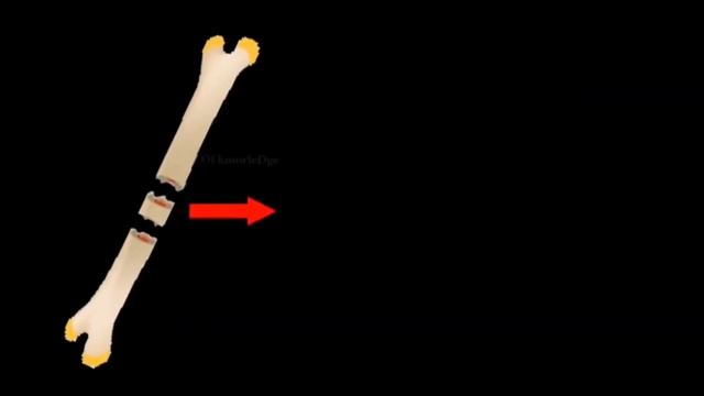 Какие бывают переломы? | ПОЛЕЗНЫЙ ЮТУБ смотреть онлайн