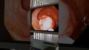 Эндоскопическая полипэктомия в сигмовидной кишке