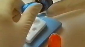 Восстановление культи зуба стекловолоконным штифтом