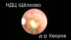 Лазерное дробление камня мочеточника с озвучиванием