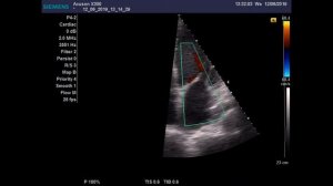 Постинфарктный кардиосклероз