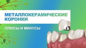 ? Металлокерамические коронки - плюсы и минусы