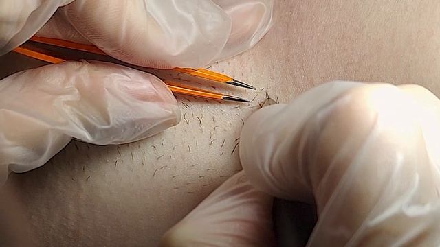 Электроэпиляция  без боли