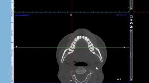 Возможности программы Romexis Viewer: настройка на многокорневой зуб