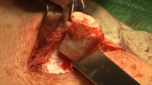 Воронкообразная деформация грудной клетки