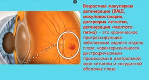 Что такое ВОЗРАСТНАЯ МАКУЛЯРНАЯ ДЕГЕНАРЦИЯ. Симптомы, причины, диагностика.
