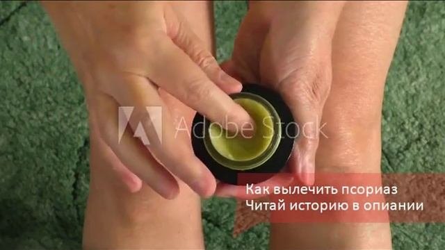 Псориаз на голове лечение в домашних условиях