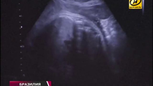 Что нужно знать о вирусе Зика белорусам ? смотреть онлайн