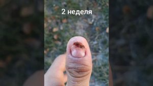 Жесть! Как растут ногти. После удаления.