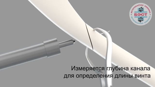 Фиксация простого косого перелома диафизарного сегмента плечевой кости смотреть онлайн