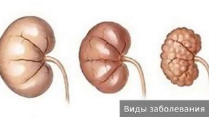 Почечная недостаточность. Как лечить почечную недостаточность.