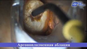 Аргоноплазменная коагуляция при лейкоплакии шейки матки