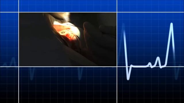 Как проводится лечение отслойки сетчатки глаза? смотреть онлайн