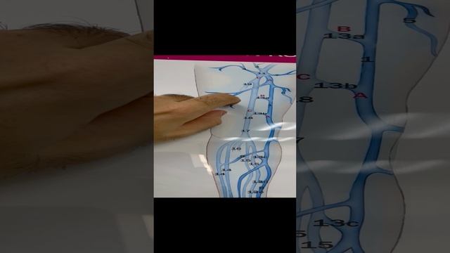 Рецидив варикоза после РЧА (радиочастотной аблации). Флеболог Москва. Флеболог. Сосудистый хирург смотреть онлайн