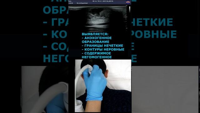 Как выглядит НАГНОИВШАЯСЯ АТЕРОМА на УЗИ?