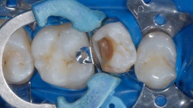Лечение кариеса боковых зубов. Реставрация композитом. Composite tooth restoration.