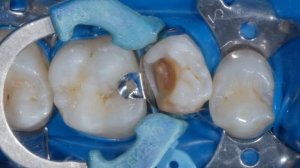 Лечение кариеса боковых зубов. Реставрация композитом. Composite tooth restoration.