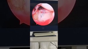 повреждение хрящевой губы плечевого сустава SLAP. Выполнена фиксация шовеыми анкерами.