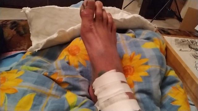 Уход за ногами. Перевязка. Что под бинтами и гипсом!? #перелом #nickb смотреть онлайн