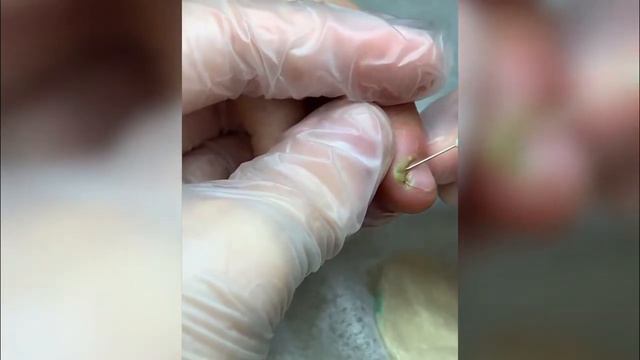 Вскрытие панариция смотреть онлайн