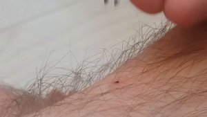 Что делать если клещ укусил человека. Действия при укусе клеща: как достать и чем обработать укус