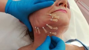 Тредлифтинг (мезонитями) нижней трети лица