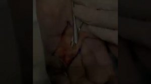 Контрактура Дюпюитрена, открытая техника апоневрэктомия.