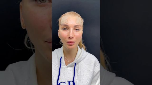 Через 3 дня после подтяжки лица и височного лифтинга смотреть онлайн