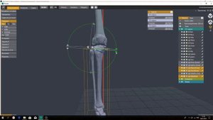 Виртуальная открывающаяся корригирующая остеотомия большеберцовой кости