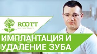 Установка импланта и удаление зуба за 1 визит. Установка импланта после удаления зуба